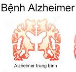 Bệnh Alzheimer ở người trẻ tuổi – Nguyên nhân, cách điều trị