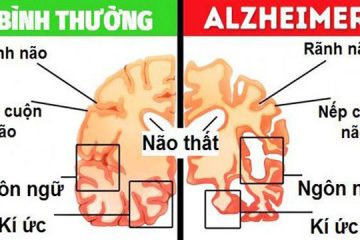 Bệnh Alzheimer là gì? Nguyên nhân, triệu chứng, cách điều trị và chăm sóc
