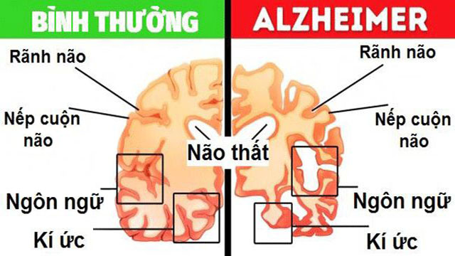 Bệnh Alzheimer là gì