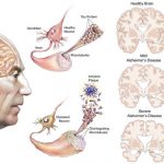 Bệnh alzheimer giai đoạn cuối| Triệu chứng và điều trị