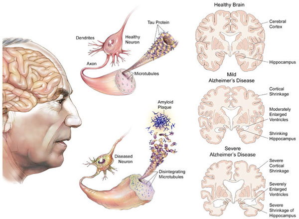 các giai đoạn của bệnh Alzheimer