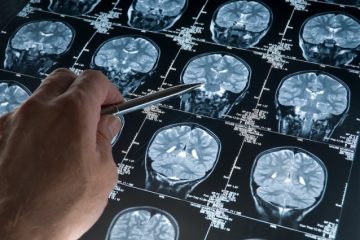 Các đặc điểm lâm sàng, xét nghiệm của bệnh Alzheimer