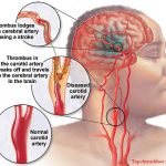 Tai biến mạch máu não có chữa được không?