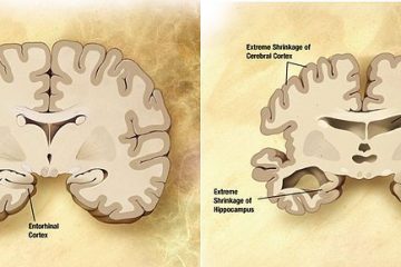 Phân biệt bệnh teo não với các bệnh lão hóa của người già