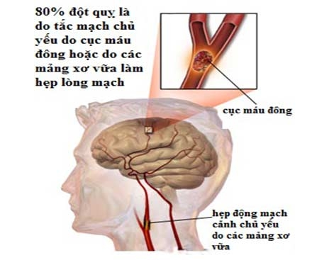 Nguyên nhân gây nên sa sút trí tuệ mạch máu 1