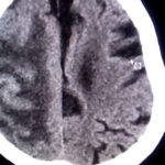 Teo não tuổi già – Nguyên nhân, hiện tượng, cách chữa bệnh