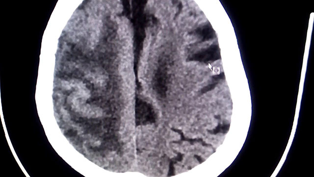 Bệnh teo não tuổi già trên CT