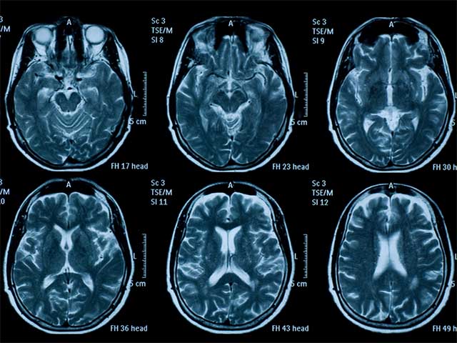 Thoái hoá não ở người trẻ trên CT
