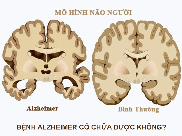 Bệnh Alzheimer có chữa được không