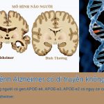Bệnh Alzheimer có di truyền không? Cách phòng ngừa bệnh Alzheimer