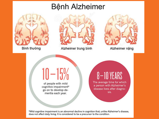 Bệnh Alzheimer sống được bao lâu